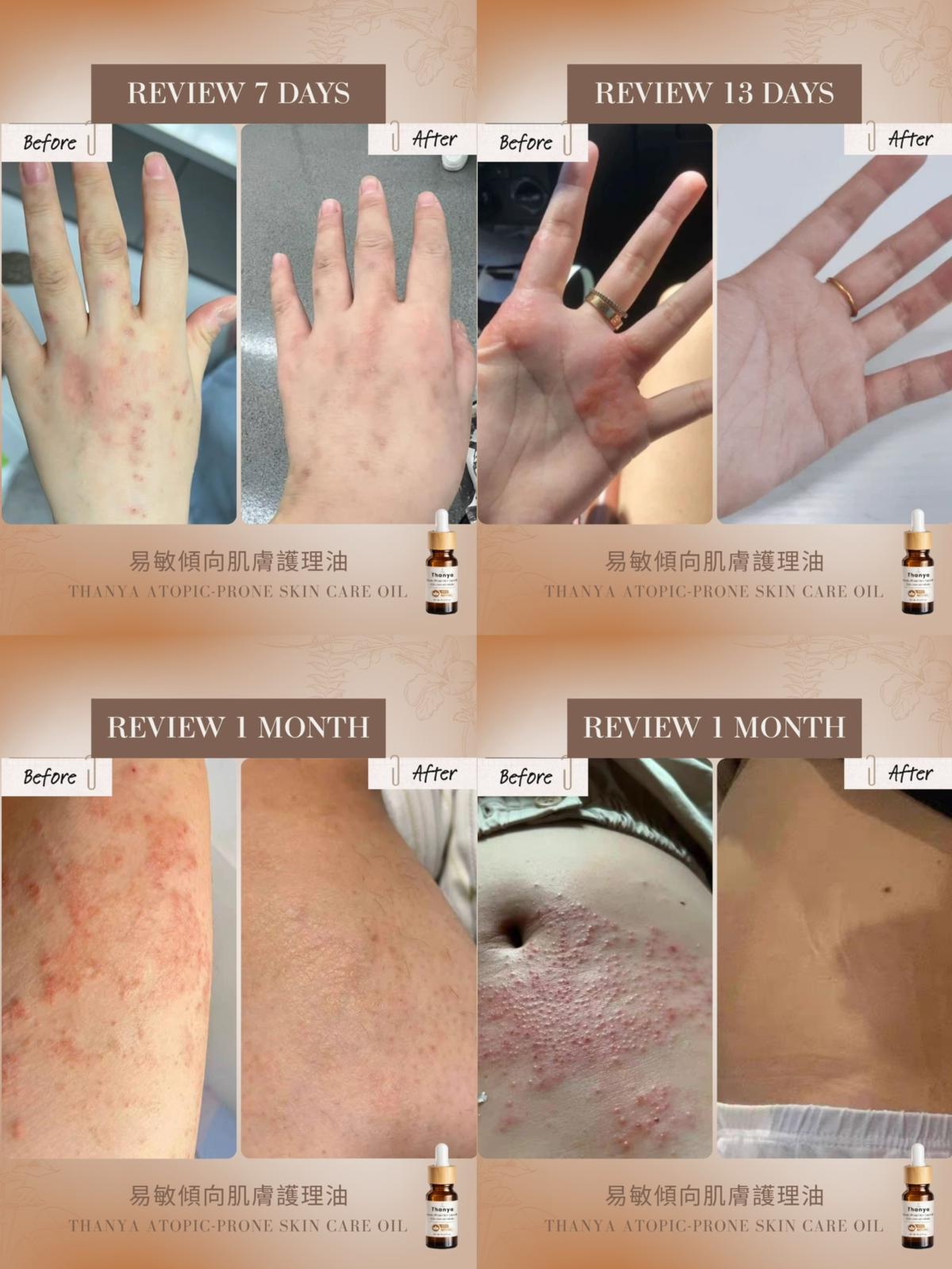 Atopic-Prone Skin Care Oil