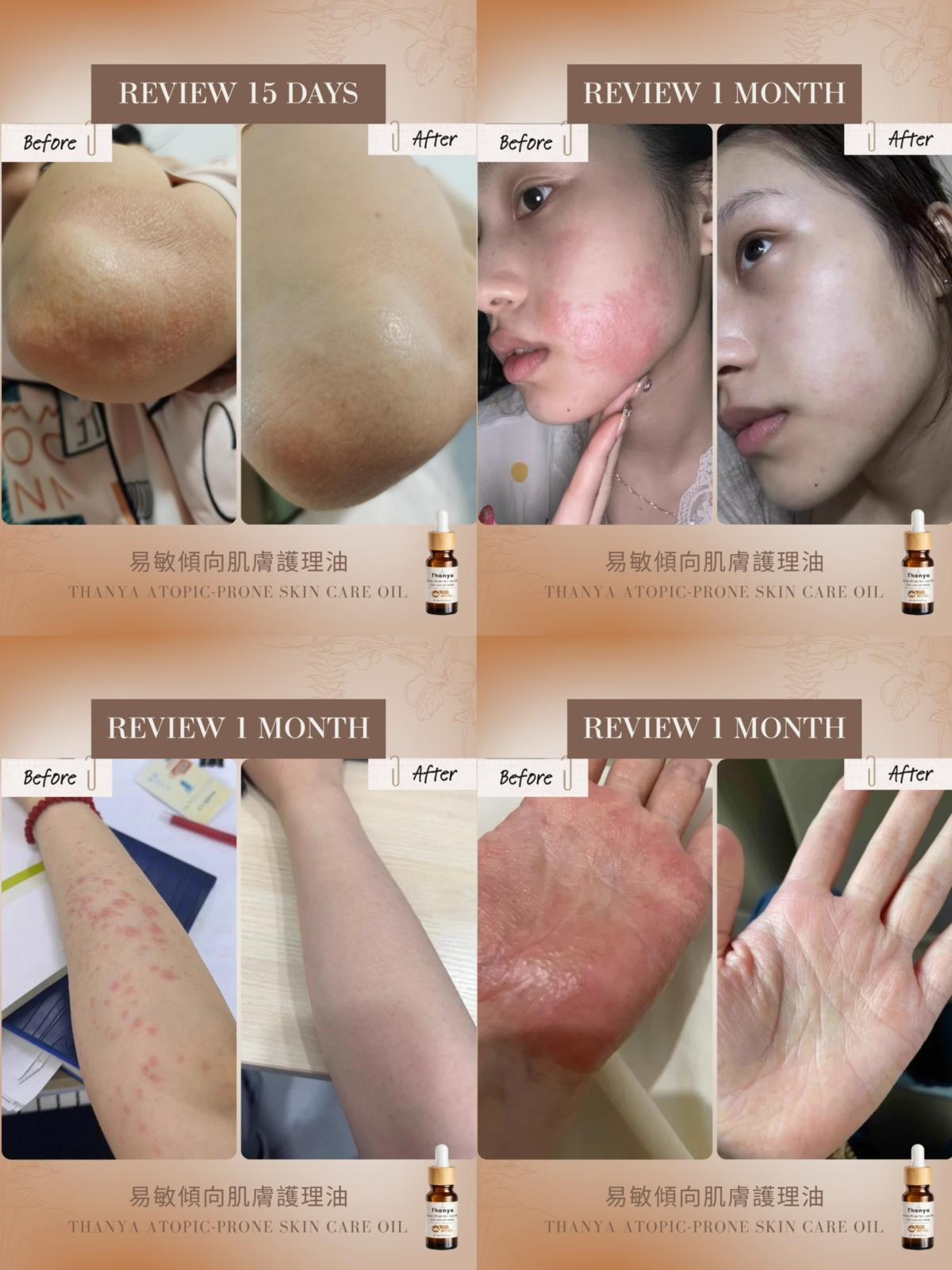 Atopic-Prone Skin Care Oil