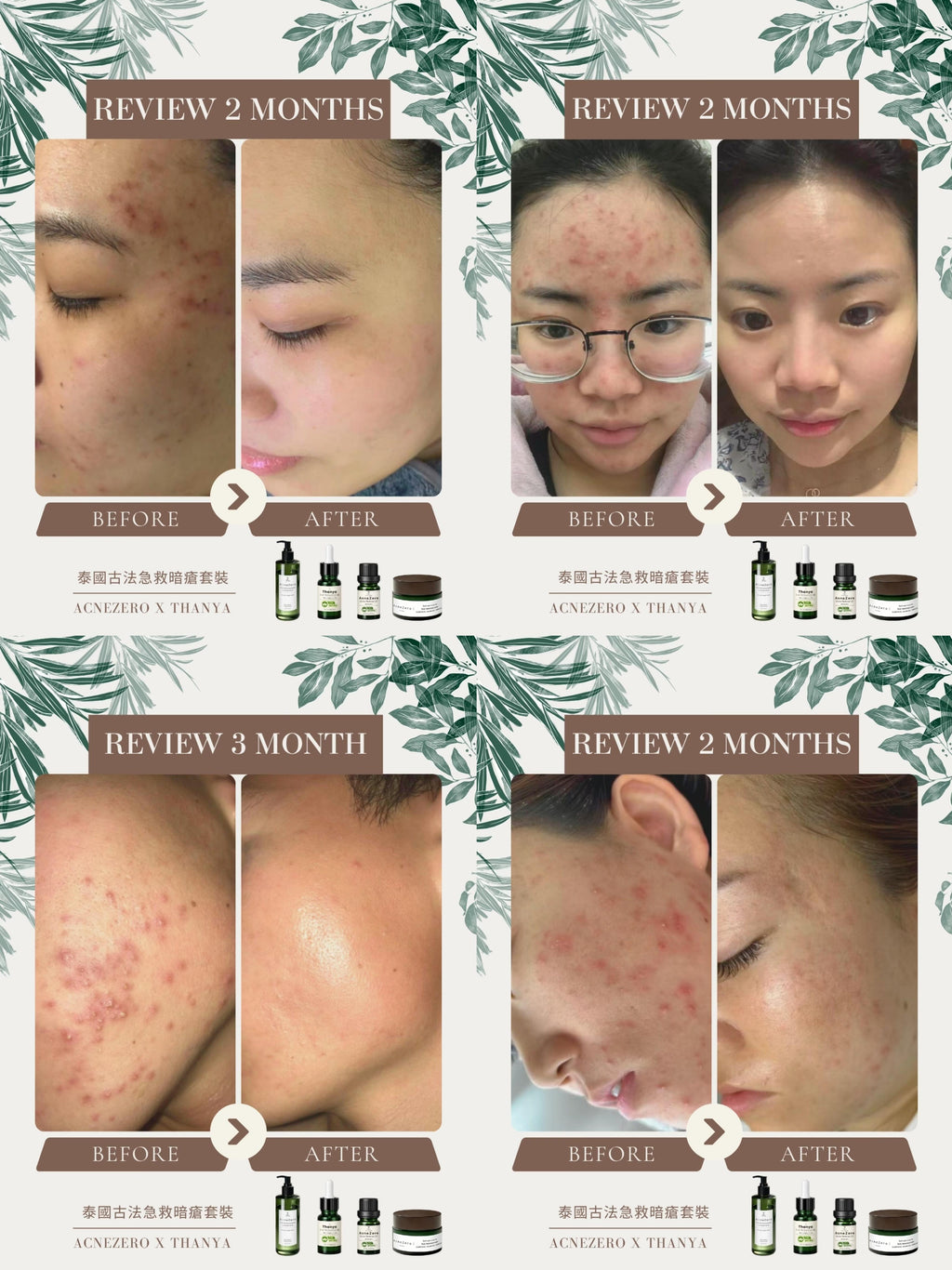 Acne Care Oil