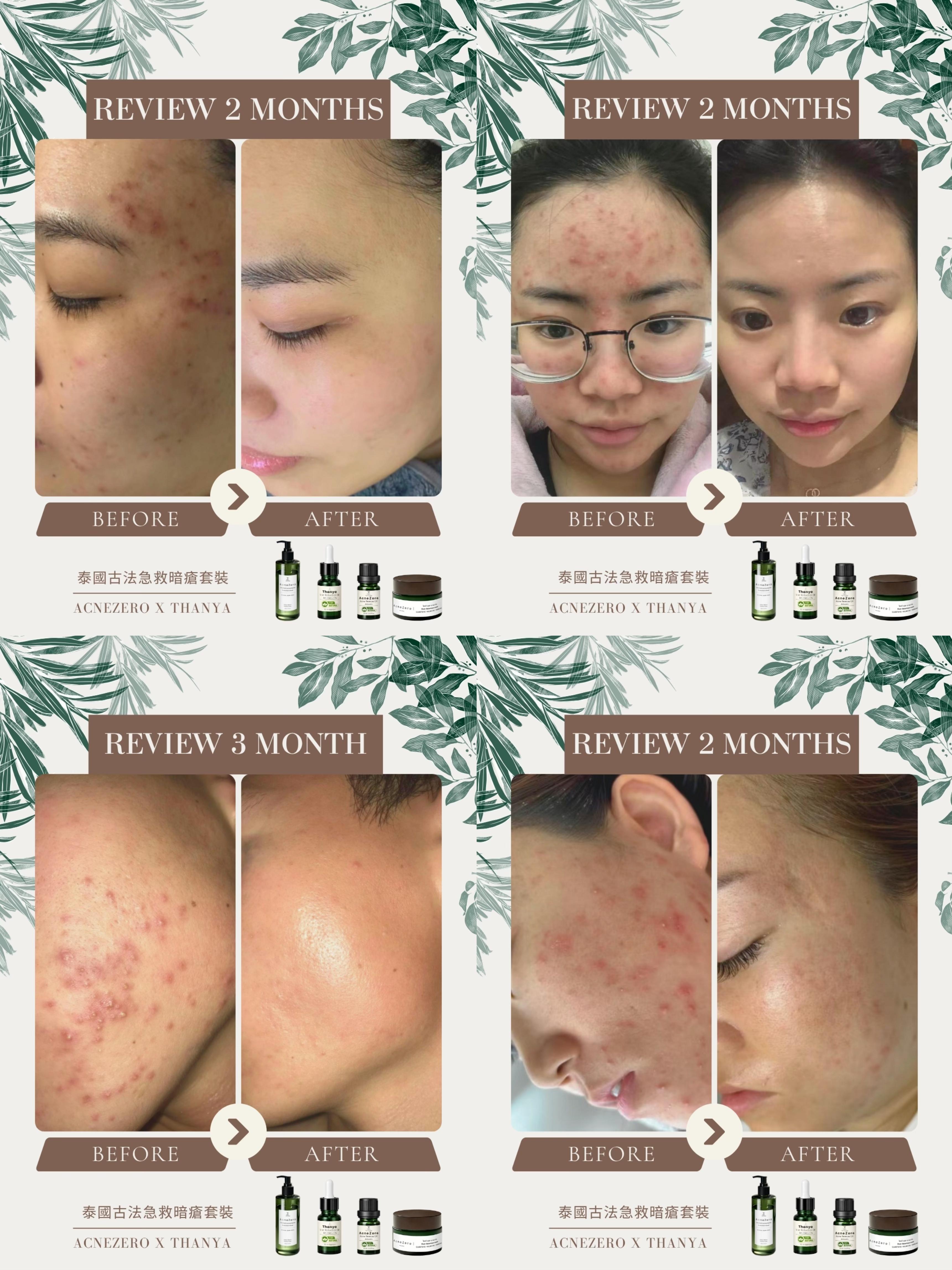 Post Acne Care Cream