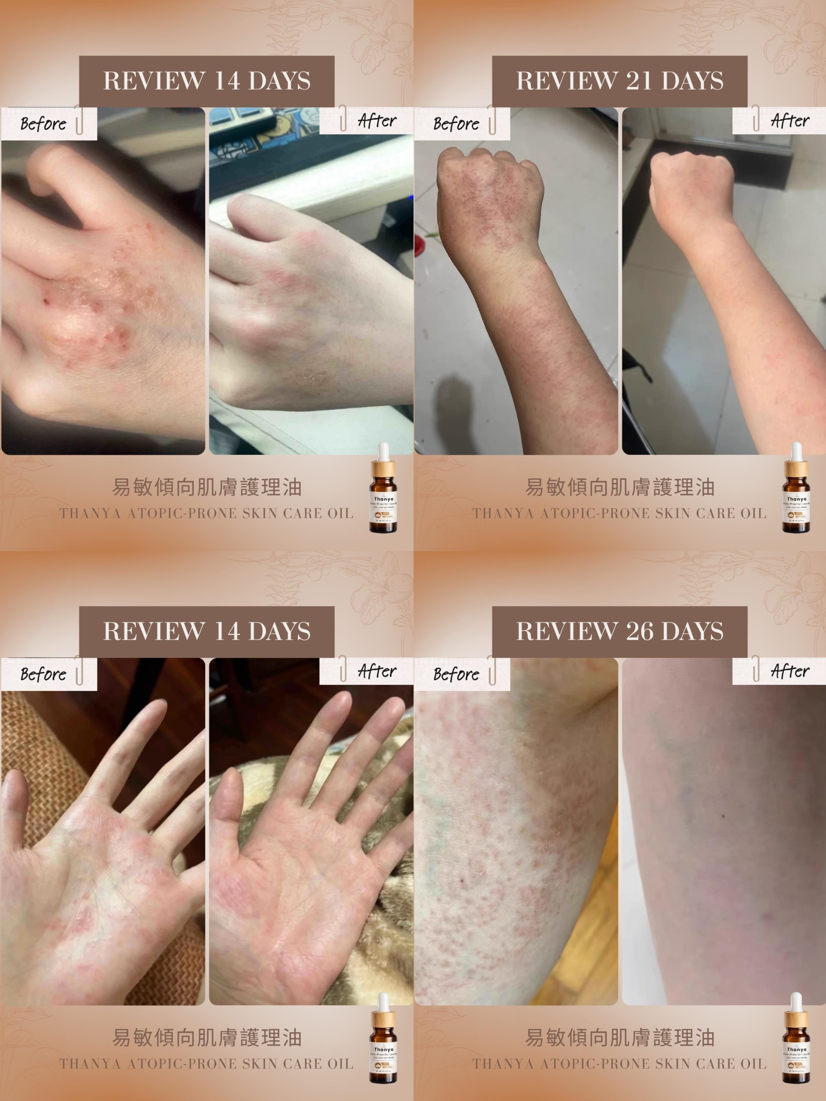 Atopic-Prone Skin Care Oil