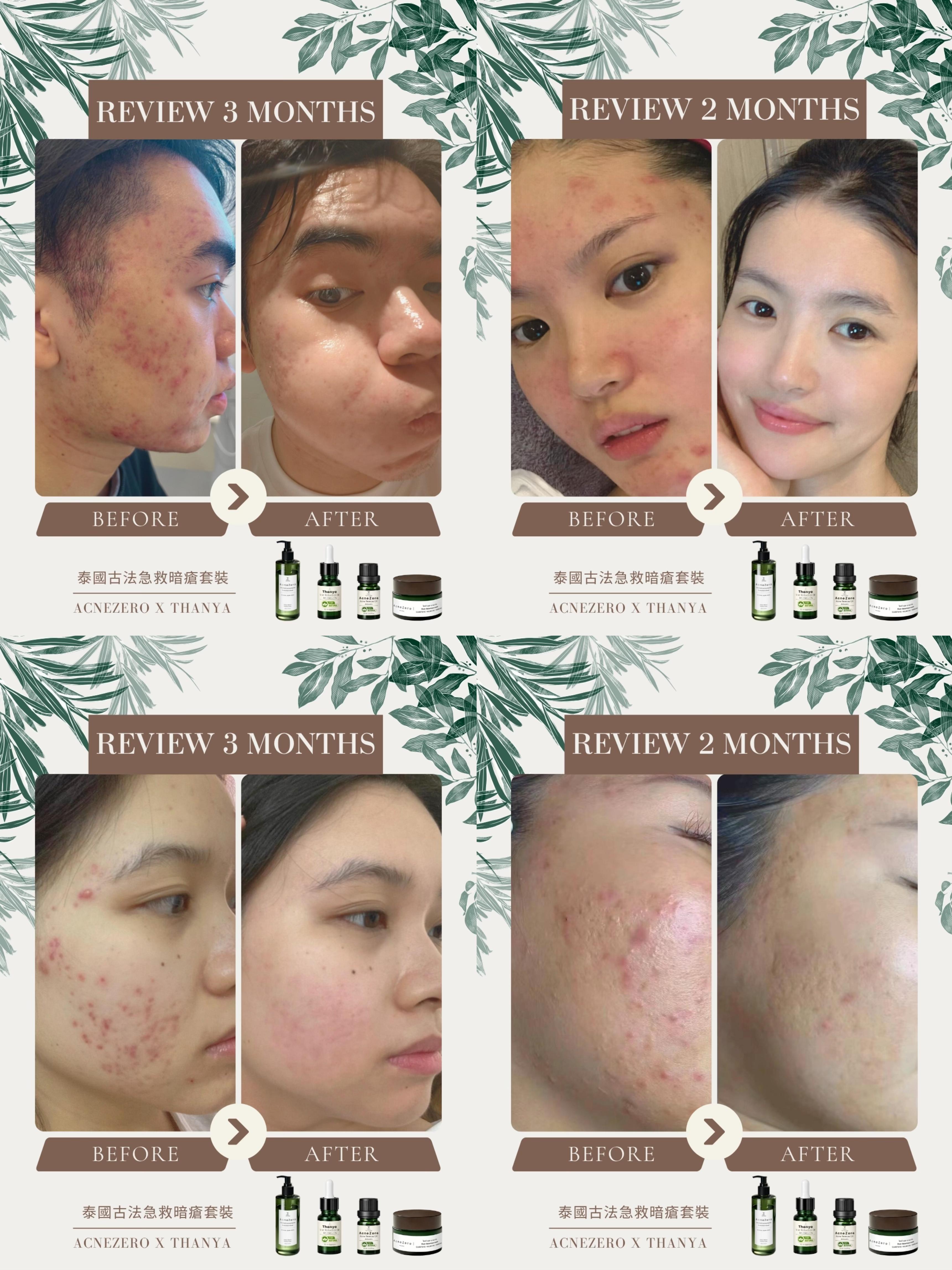 Post Acne Care Cream