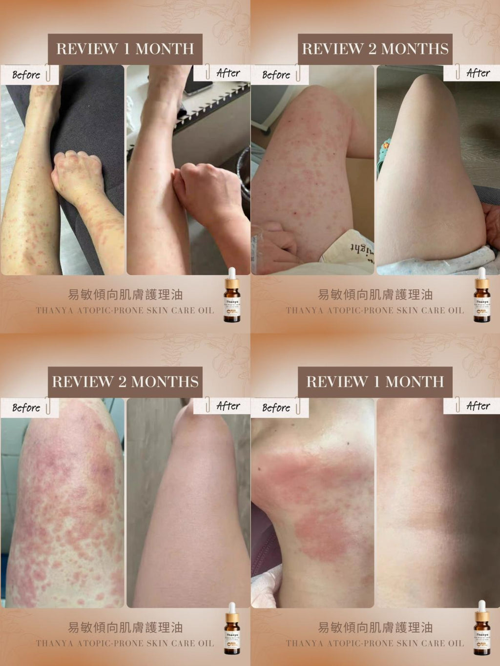 Atopic-Prone Skin Care Oil