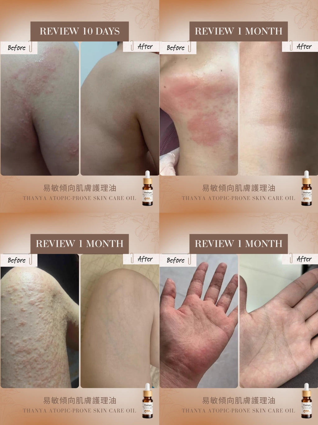 Atopic-Prone Skin Care Oil