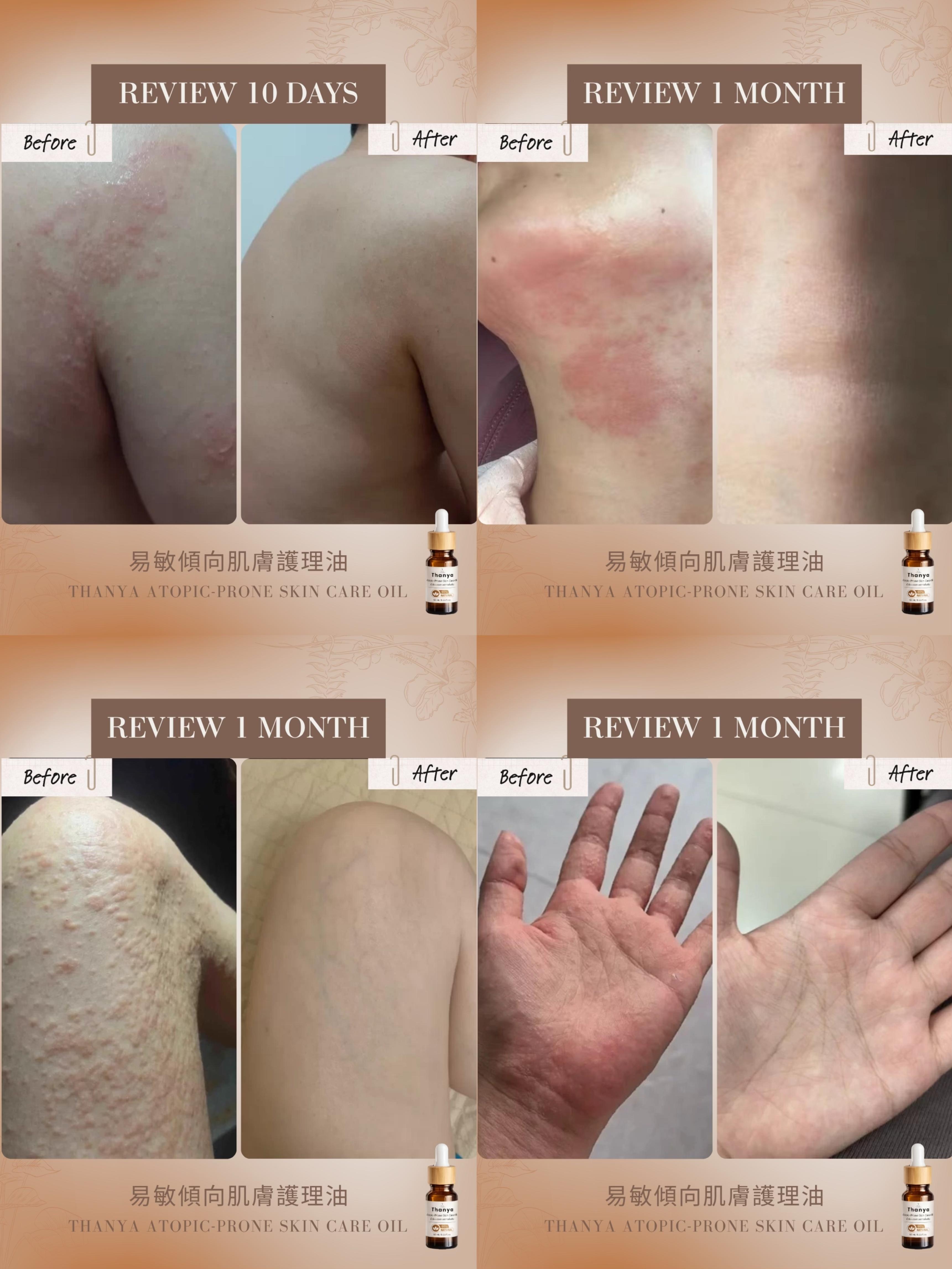 Atopic-Prone Skin Care Oil