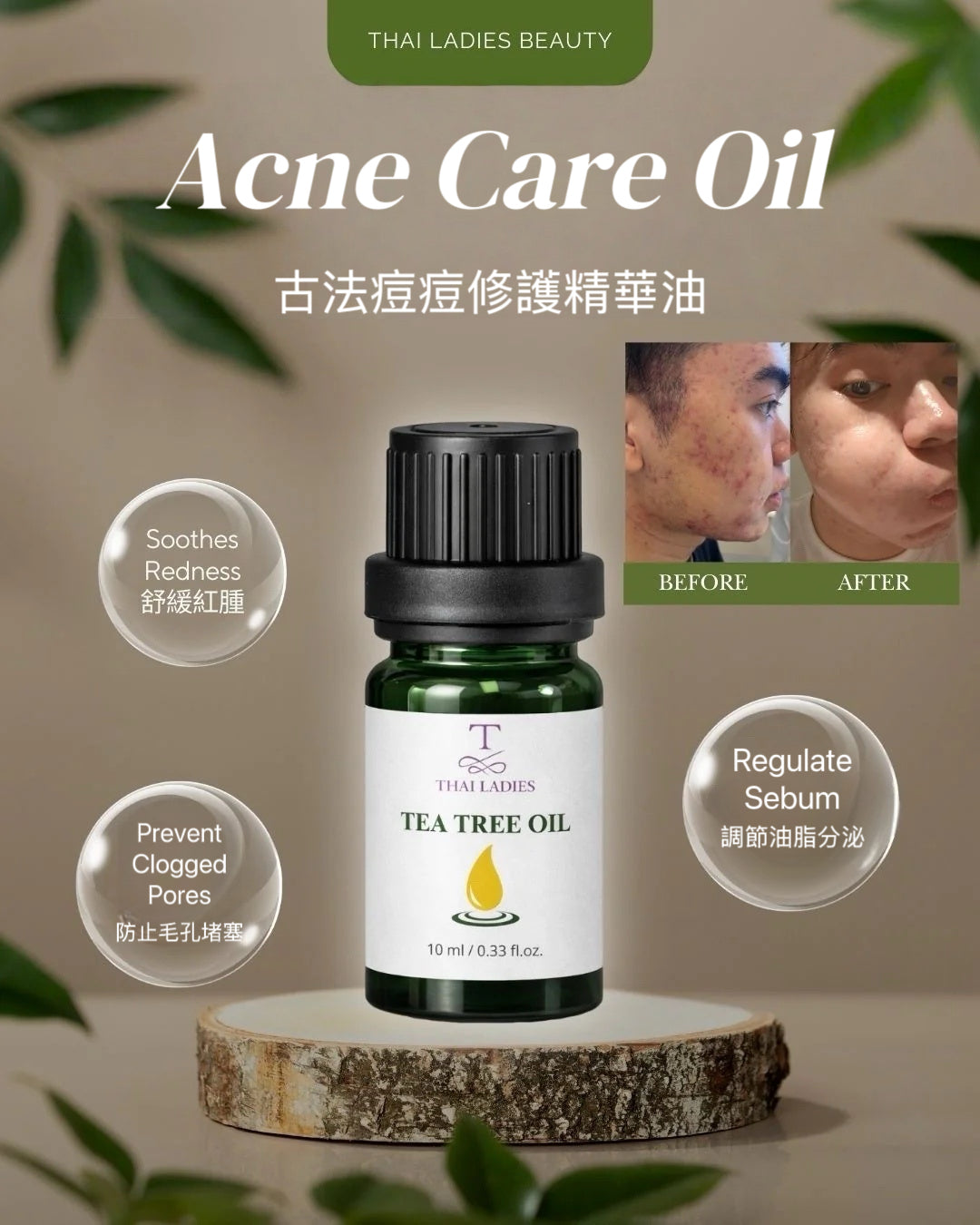 Ancient Remedy Acne Skin Care Set