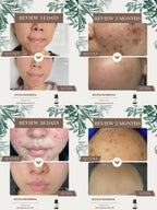 Moringa Scar Care Oil