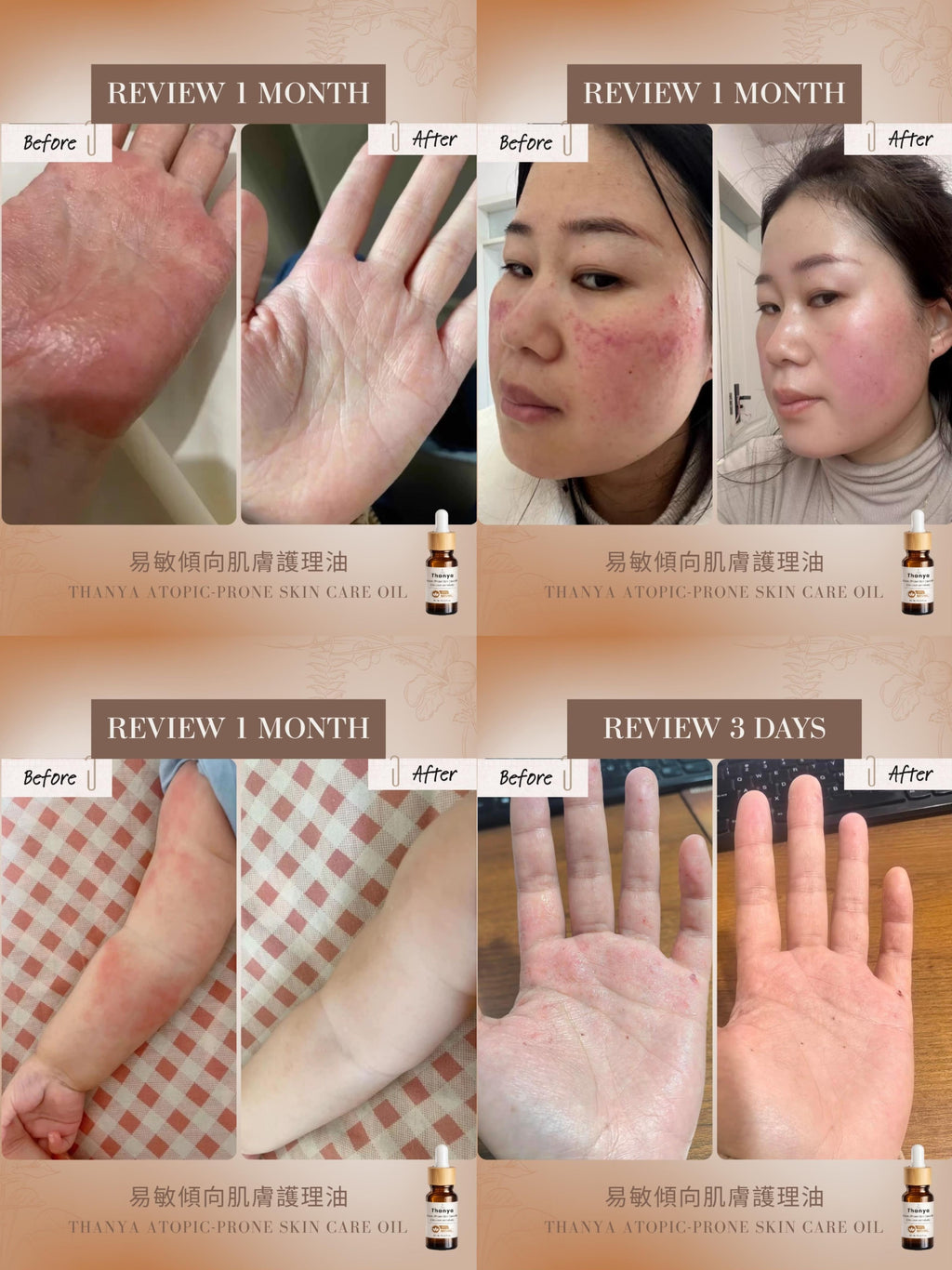 Atopic-Prone Skin Care Oil