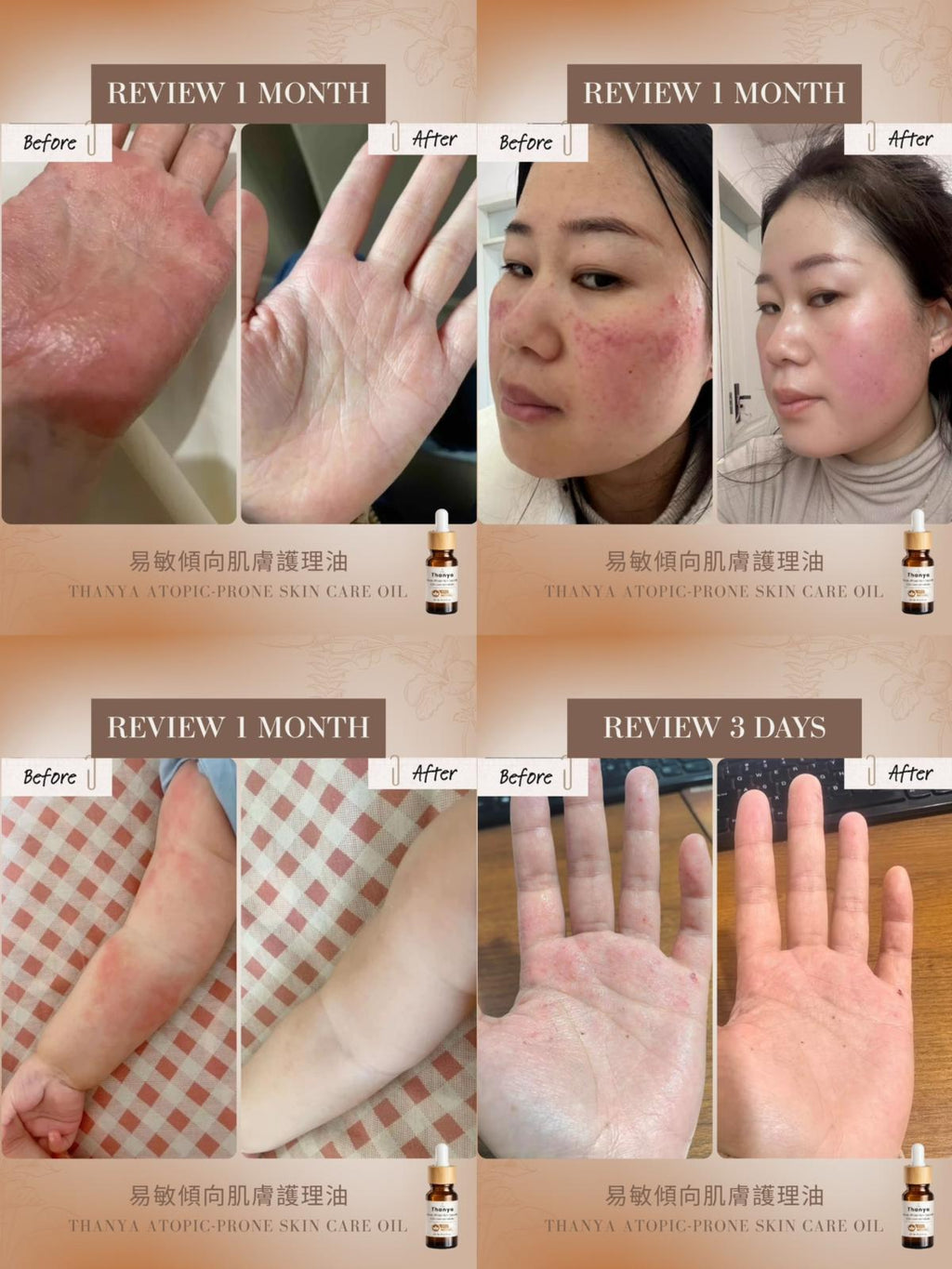 Atopic-Prone Skin Care Oil
