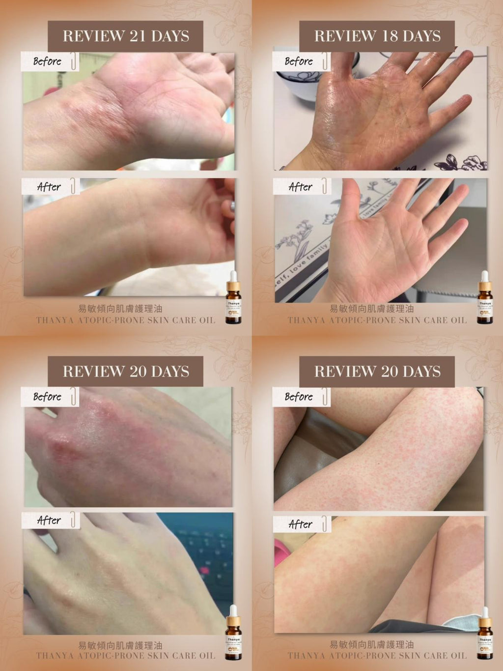 Atopic-Prone Skin Care Oil