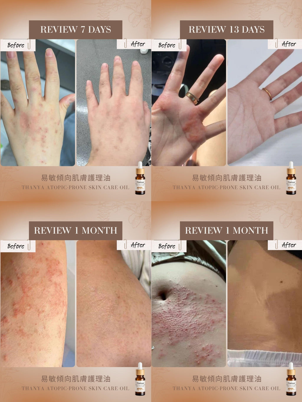 Atopic-Prone Skin Care Oil