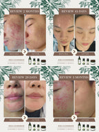Acne Care Oil 2.0