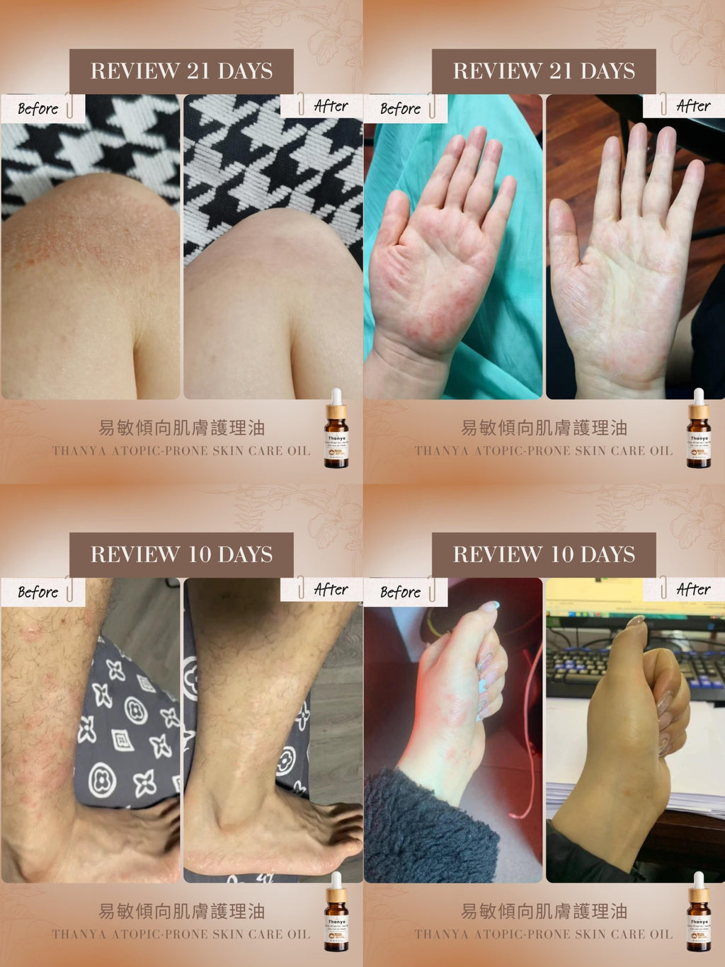 Atopic-Prone Skin Care Oil