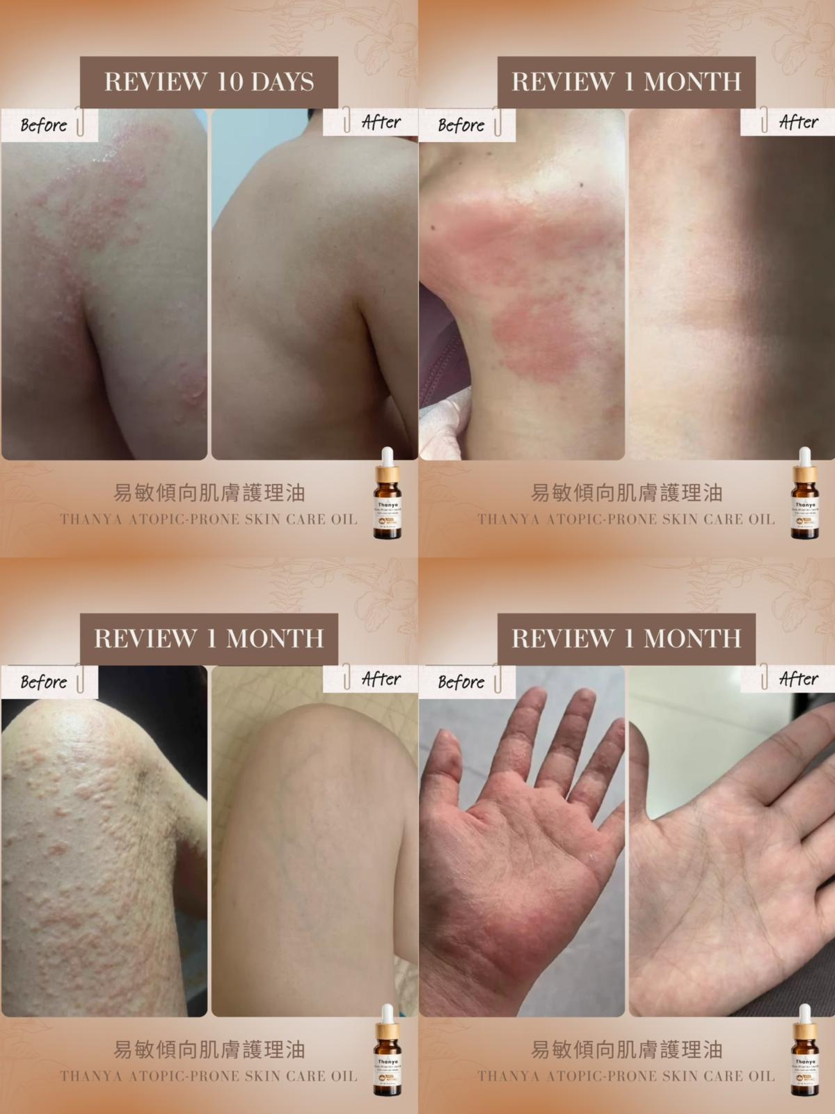 Atopic-Prone Skin Care Oil